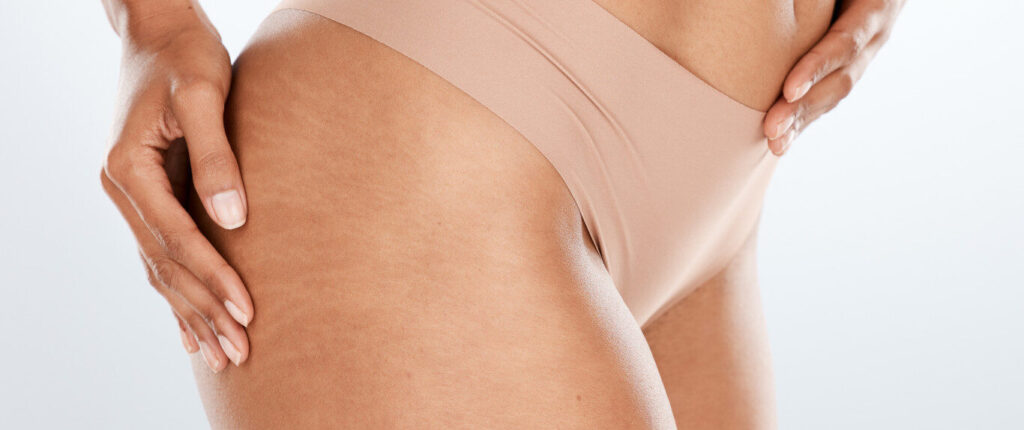 Intracel para Estrias